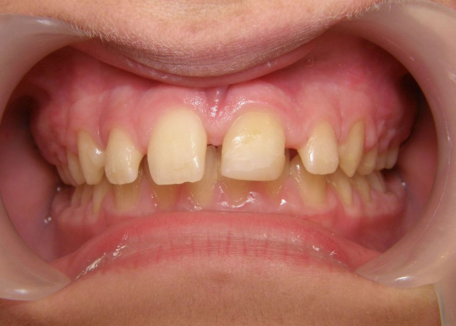 orthodontiste_geneve_avant