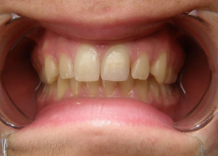 orthodontiste_geneve_apres