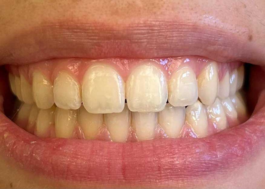 orthodontiste_geneve_apres