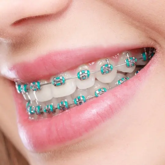 OrthoLight - Orthodontie Conventionnelle