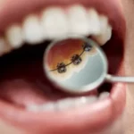 OrthoLight - Orthodontie Linguale