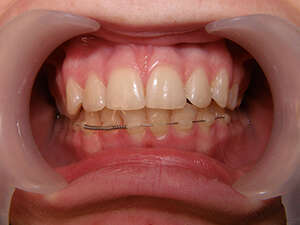 molders geneve ortholight