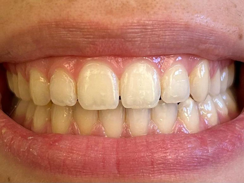 Gouttières transparentes adulte résultat - OrthoLight Genève