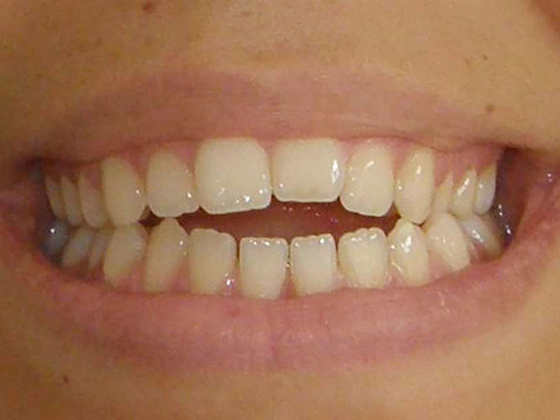 Gouttières transparentes adulte avant - OrthoLight Genève