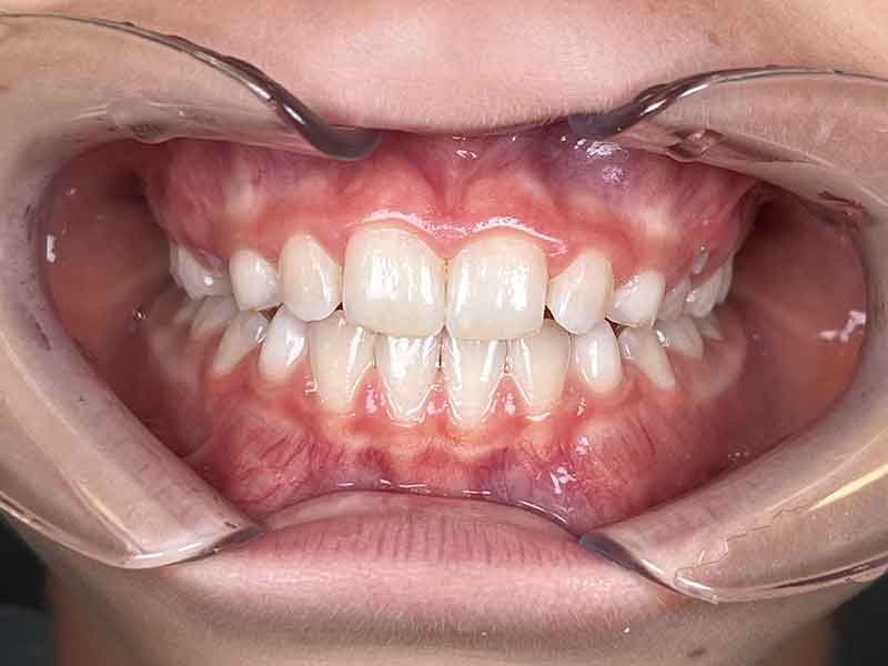 Orthodontie interceptive enfant résultat - OrthoLight Genève