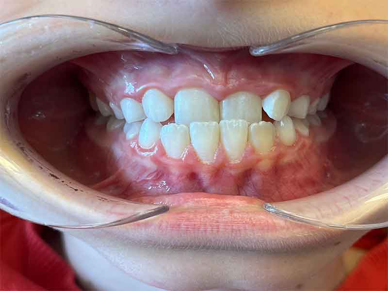 Orthodontie interceptive enfant avant - OrthoLight Genève