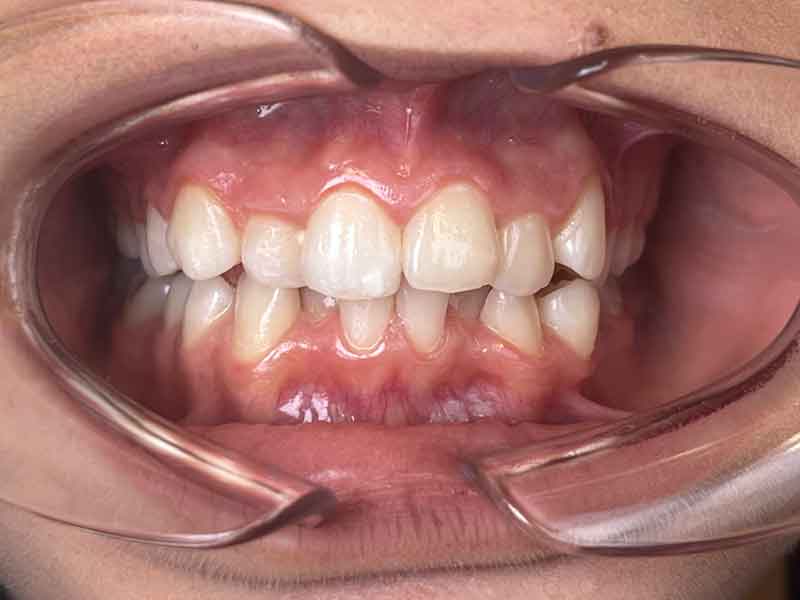 Plaque expansion orthodontique enfant après traitement - OrthoLight Genève