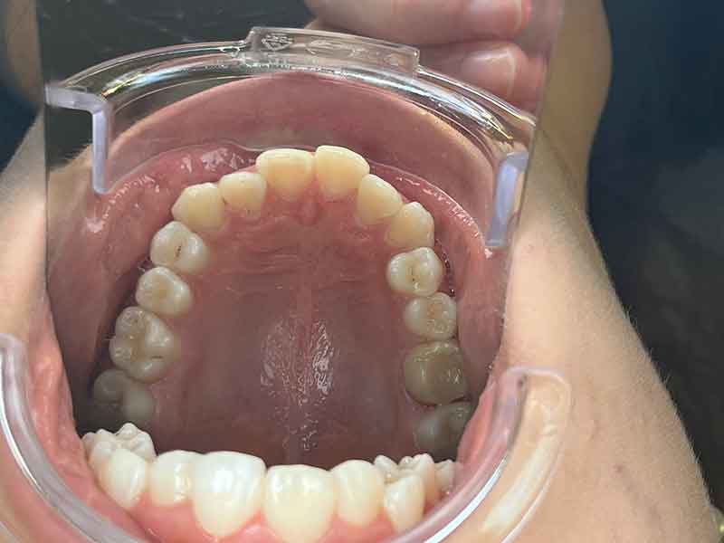 Plaque expansion orthodontique enfant après traitement - OrthoLight Genève