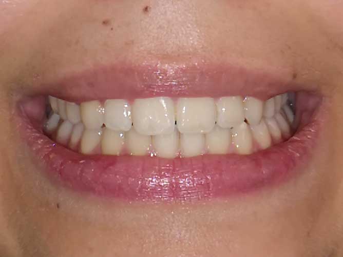 Gouttières transparentes adulte après 24 mois de traitement - OrthoLight Genève