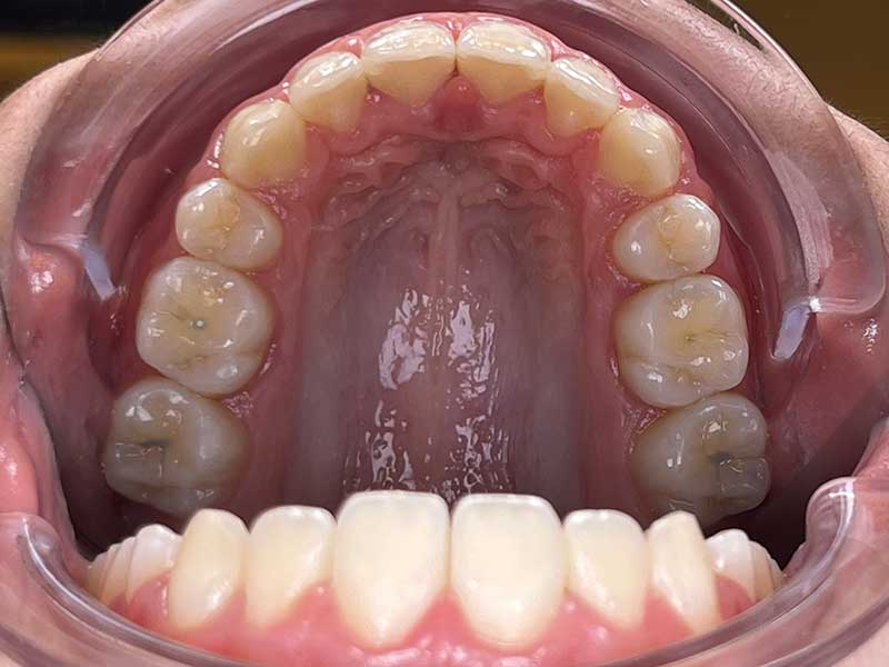 Bagues orthodontiques adolescent résultat après 30 mois - OrthoLight Genève