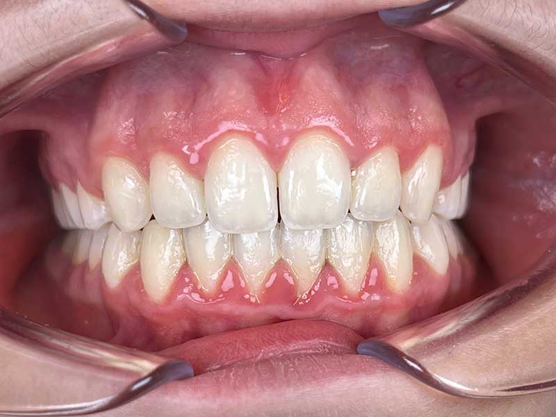 Bagues orthodontiques adolescent résultat après 30 mois - OrthoLight Genève