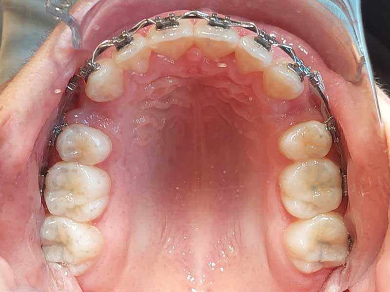 Bagues orthodontiques adolescent traitement en cours - OrthoLight Genève