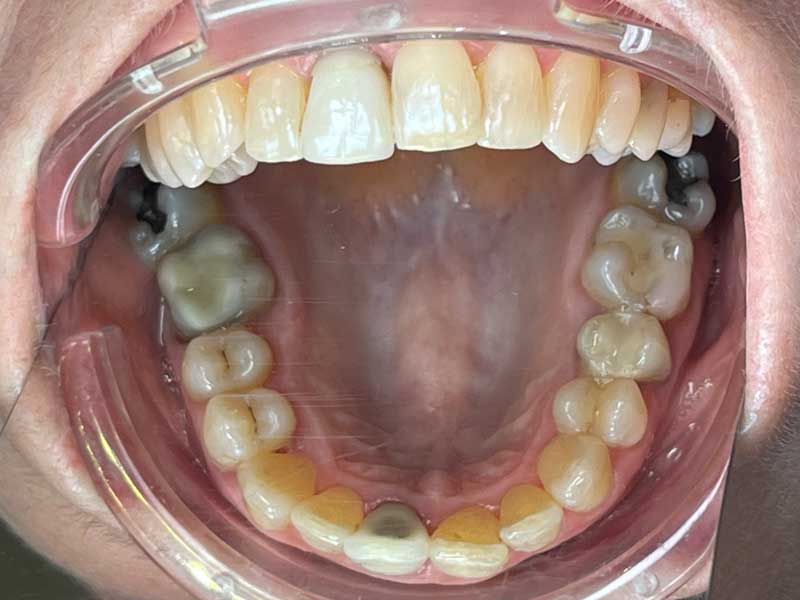 Traitement mixte sénior 60 ans résultat - OrthoLight Genève