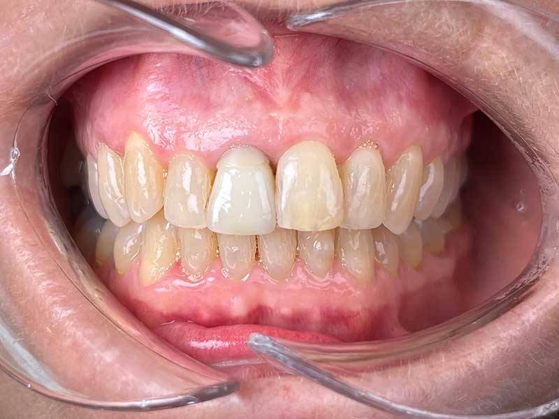 Orthodontie sénior 60 ans résultat - OrthoLight Genève