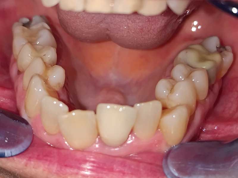 Traitement mixte sénior 60 ans avant - OrthoLight Genève