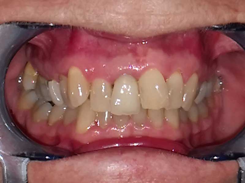 Orthodontie sénior 60 ans avant - OrthoLight Genève