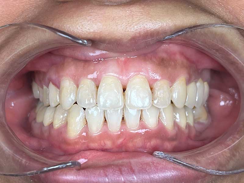 Traitement orthodontique mixte sénior 60 ans résultat - OrthoLight Genève